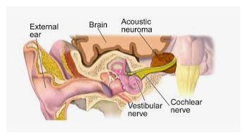 Meniere's disease or acoustic neuroma? - Image showing position of acoustic near the inner ear