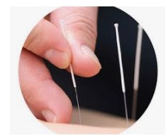 acupuncture for Meniere's disease - image showing acupuncture needles being worked