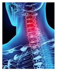 Chiropractics for Meniere's disease - image showing inflamed cervical spine