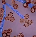 Candida Albicans and Meniere's Disease - image of candida overgrowth