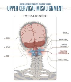 Meniere's Disease and Cervical Spine - diagram showing upper cervical misalignment