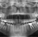 x-ray showing amalgam leakage