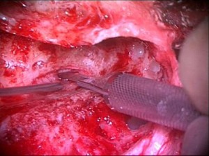 Meniere_edolymphatic_shunt_implant