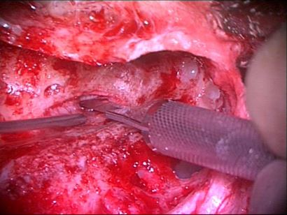 Surgery for Meniere's Disease: image of inner ear surgery