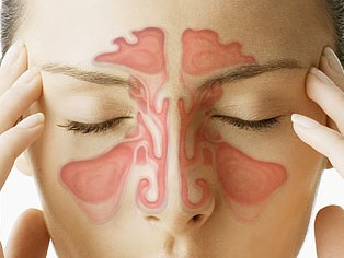 Sinuses and Meniere's disease - face of woman depicting the position of the sinuses