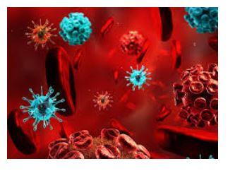 Autoimmune connections to Meniere's disease - image of autoimmune response in blood vessels