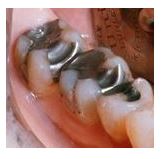Amalgam mercury and Meniere's disease - image of amalgam dental fillings