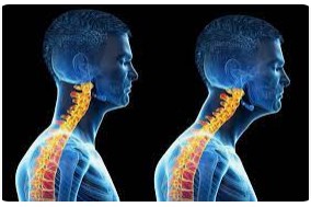Forward head posture showing misaligned cervical spine causing vertigo. Posture and vertigo are linked.